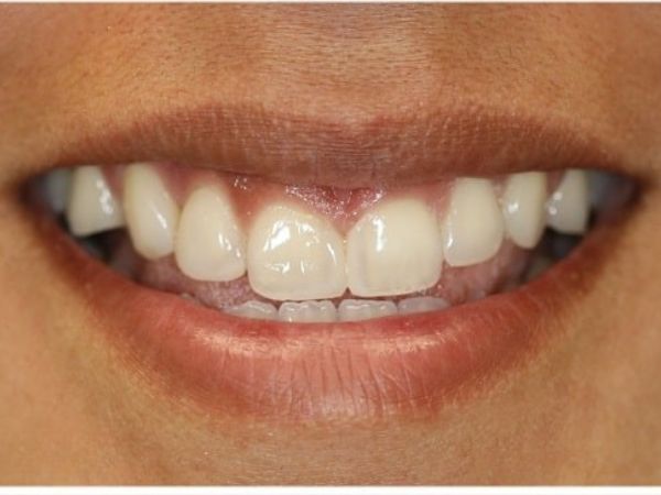 After cosmetic fillings treatment