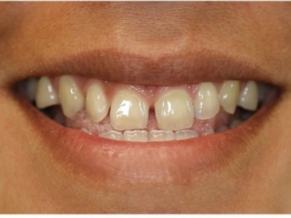 Before cosmetic fillings treatment